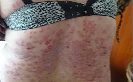 銀屑病有什么癥狀