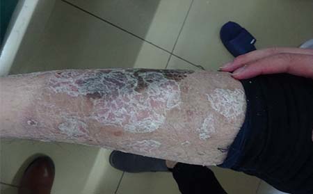 銀屑病應該怎么護理