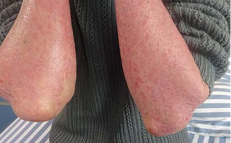 銀屑病應該怎么注意護理