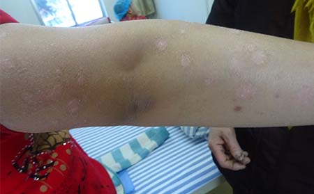 什么樣的癥狀是銀屑病