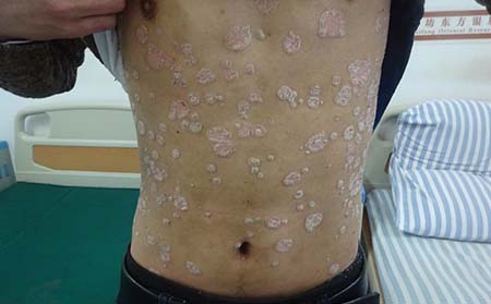 銀屑病患者應該怎么進行護理