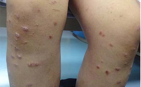 銀屑病應該怎么治療