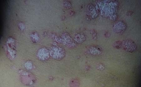 銀屑病的癥狀有什么