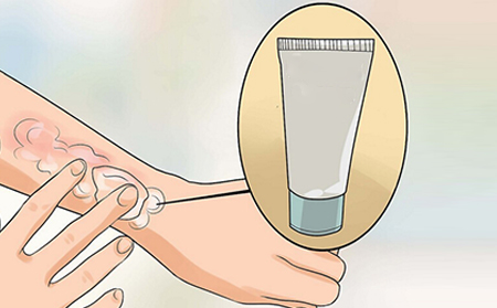 為什么會發生銀屑病