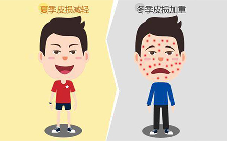 銀屑病應該怎么進行治療