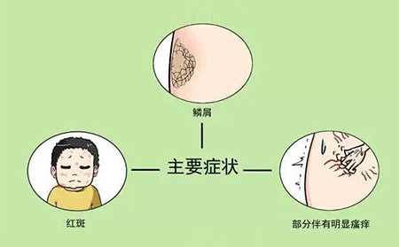 銀屑病的癥狀有什么