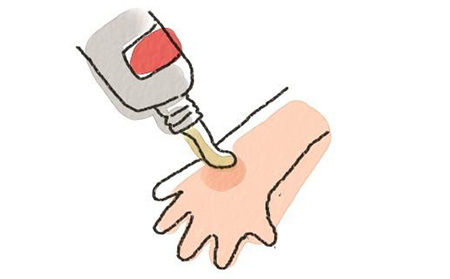 銀屑病發生時的癥狀有什么