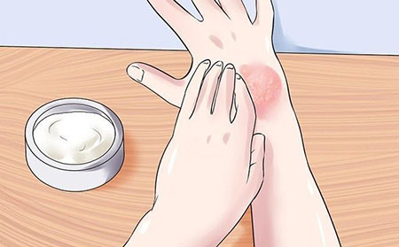 銀屑病的癥狀有什么