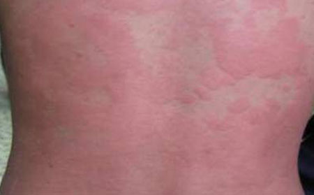 銀屑病應該怎么進行預防