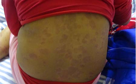 導致銀屑病的原因有什么