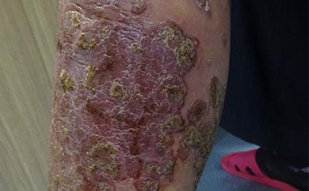 銀屑病應該怎么進行護理