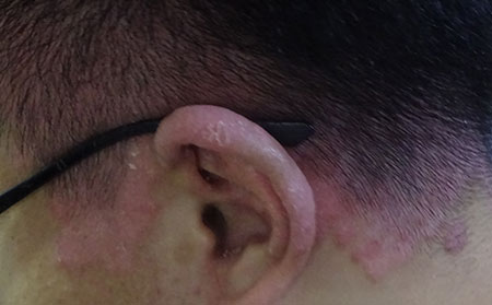 銀屑病會發生在那些人身上