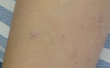 銀屑病有什么癥狀