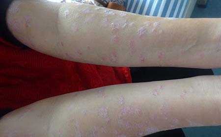 銀屑病應(yīng)該怎么護理