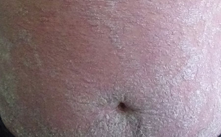 銀屑病的護(hù)理方法有什么