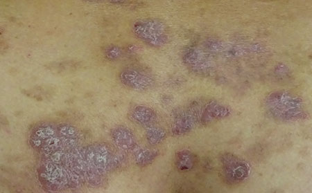 銀屑病患者應(yīng)該怎么注意飲食