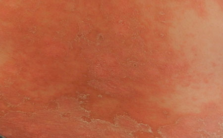 什么樣的癥狀是銀屑病