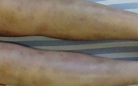 如何進行銀屑病的科學防治