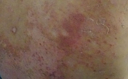 銀屑病應(yīng)該怎么護(hù)理