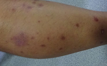 銀屑病的常見癥狀都有哪些