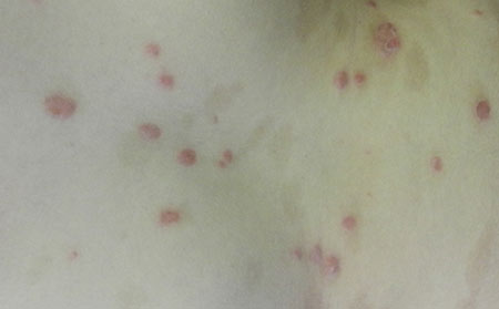 銀屑病的護理方法有什么