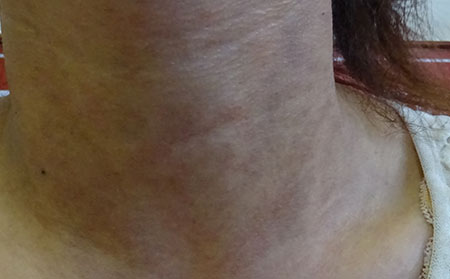 導致尋常型銀屑病惡化的原因是什么