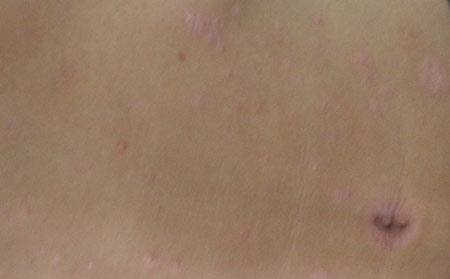 銀屑病應該怎么進行護理