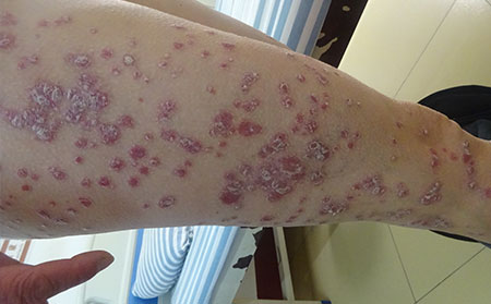 銀屑病的護(hù)理方法有什么