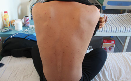 銀屑病怎么進行預(yù)防