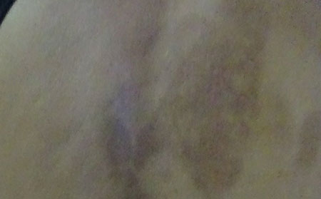 銀屑病的預防方法