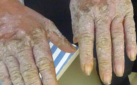 銀屑病應(yīng)該怎么治療