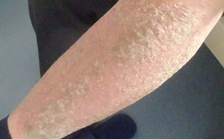 銀屑病的日常護理