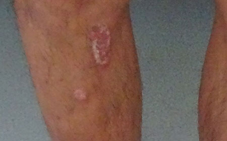 銀屑病的癥狀有什么