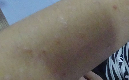 銀屑病應該怎么護理