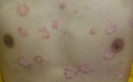 銀屑病治療需要多久