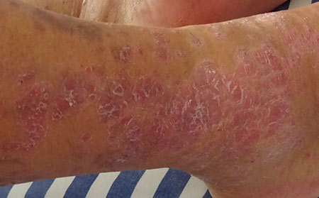 銀屑病發生的病因有哪些呢