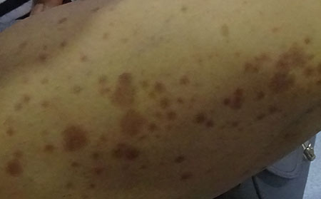 銀屑病應(yīng)該怎么科學(xué)止癢