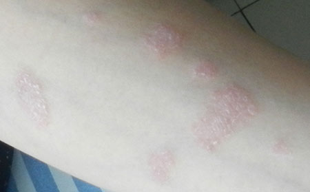 導致銀屑病的原因有什么