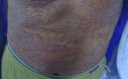 銀屑病發(fā)生的癥狀有什么