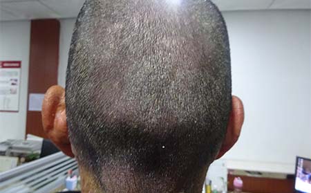 濰坊銀屑病初期有什么癥狀