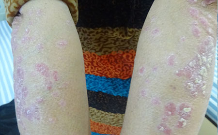 濰坊銀屑病有什么癥狀