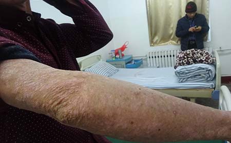 銀屑病在濰坊應(yīng)該怎么預(yù)防