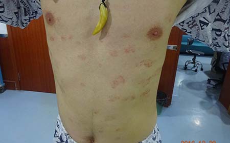 銀屑病在濰坊治療需要注意什么