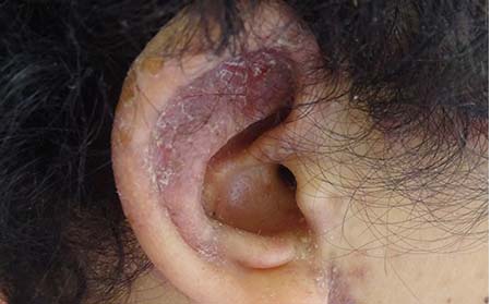 在濰坊銀屑病發生之后為什么會脫屑