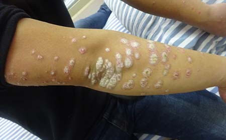 濰坊銀屑病怎么進行日常護理