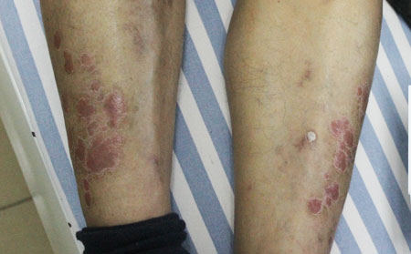 遠離銀屑病,濰坊東方銀屑病研究院,濰坊哪家醫(yī)院治療銀屑病可以