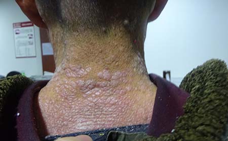 銀屑病病因,濰坊東方銀屑病研究院,濰坊銀屑病的皮膚病醫(yī)院