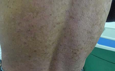 預防牛皮癬的原則,濰坊東方銀屑病研究院,濰坊能看銀屑病的是哪家