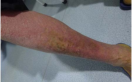 牛皮癬癥狀,濰坊東方銀屑病研究院