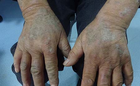 關(guān)節(jié)型銀屑病,濰坊關(guān)節(jié)型銀屑病在哪里治療比較好